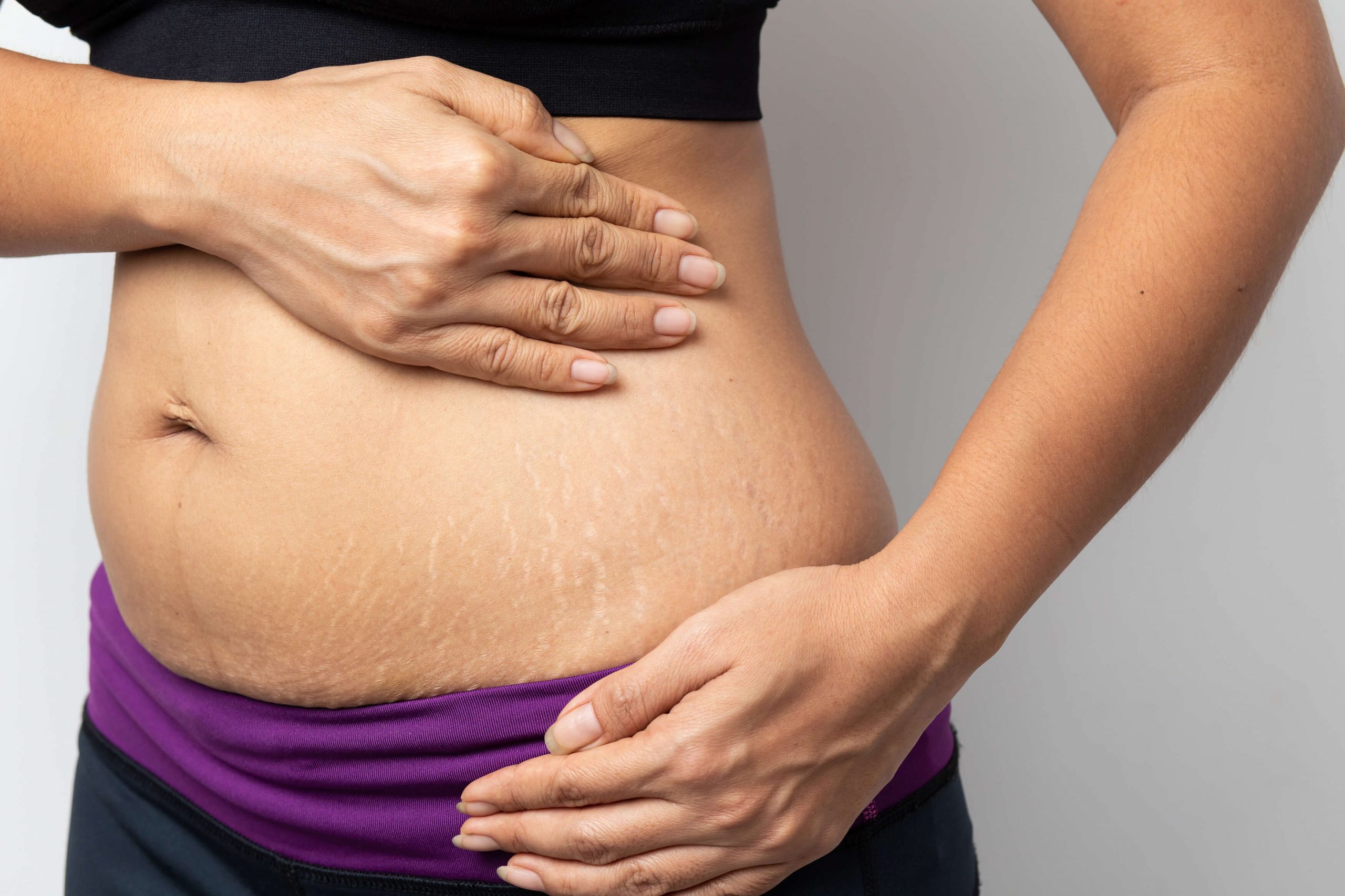 are stretch marks a sign of weight loss? - gmedia