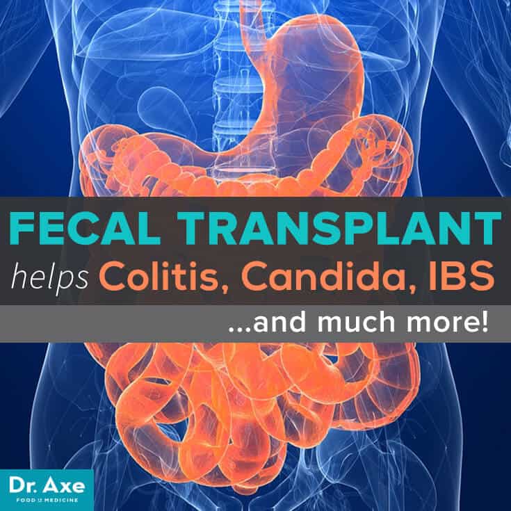 Fecal Transplant Can It Help Colitis Candida Ibs and More - gmedia