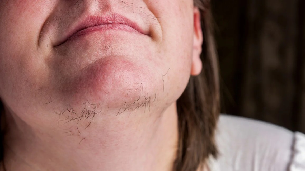 does hirsutism go away with weight loss? - gmedia