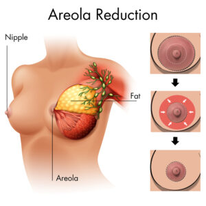 does areola shrink with weight loss? - gmedia