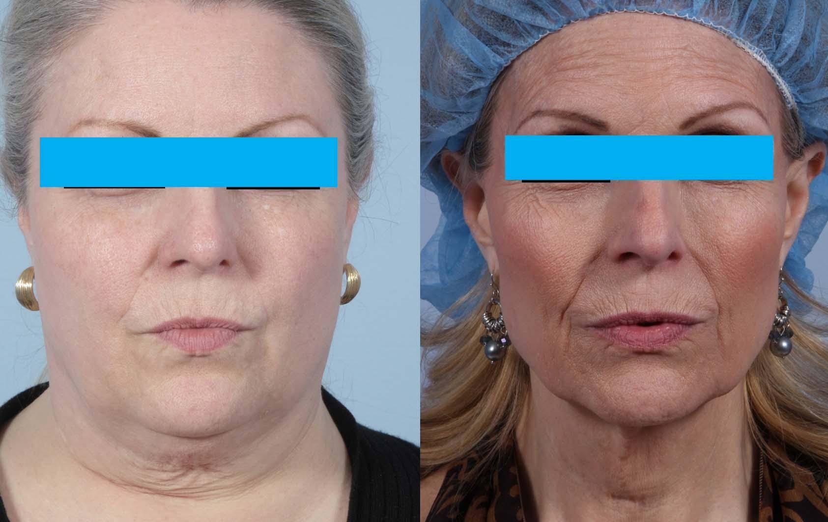 does weight loss surgery make you look old? - gmedia